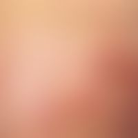 Dermatitis herpetiformis:&nbsp;gruppierte, urtikarielle Papeln mit 2-4 mm großen Erosionen und Kr...