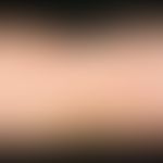Dermatitis herpetiformis. 3 months recurrent, disseminated, papules and vesicles on distinct eryt...