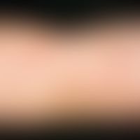 Dermatitis herpetiformis:&nbsp;seit 3 Monaten rezidivierend auftretende, disseminierte, Papeln un...