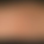 Dermatitis herpetiformis. multiple, disseminated standing, itchy, scratched excoriations on the r...
