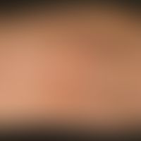 Dermatitis herpetiformis. Multiple, disseminiert stehende, juckende, zerkratzte Exkoriationen am ...