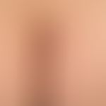 dermatitis herpetiformis. multiple, itchy, scratched excoriations on the buttocks of a 15-year-ol...
