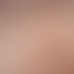 Dermatitis herpetiformis. multiple, chronically active, approx. 0.2 x 0.3 cm in size, asymmetrica...