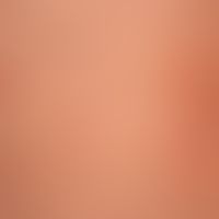 Dermatitis herpetiformis. detailed view of several, chronically active, disseminated papules, red...