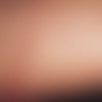 Dermatitis medusica:&nbsp;akute, etwa 6 Std. nach Kontakt mit einer Feuerqualle (Ostsee) am Obers...