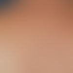 Dermatitis medusica: In dieser Übersichtsaufnahme, 3 Wochen nach dem Kontakt-Ereignis, Darstellun...