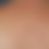 Dermatitis medusica: In dieser Übersichtsaufnahme, 3 Wochen nach dem Kontakt-Ereignis, Darstellun...
