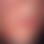 Dermatitis perioralis. periorally localized, large red spots, smallest follicular vesicles and pa...