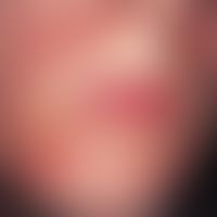 Dermatitis perioralis. periorally localized, large red spots, smallest follicular vesicles and pa...