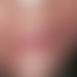 Dermatitis perioralis. solitary, chronically active, centrofacially localised (white perioral bor...