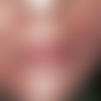 Dermatitis perioralis. solitary, chronically active, centrofacially localised (white perioral bor...
