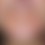 Dermatitis perioralis, granulomatous type. multiple, chronically dynamic, continuously increasing...