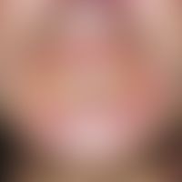 Dermatitis perioralis, granulomatous type. multiple, chronically dynamic, continuously increasing...