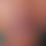Dermatitis perioralis. perioral localized, flat redness (compare the surrounding normal skin), fo...