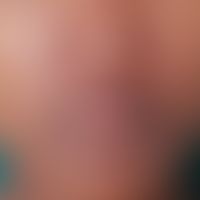Dermatitis perioralis. perioral localized, flat redness (compare the surrounding normal skin), fo...