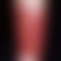 Dermatitis, phototoxische. Etwa 48 Stunden alte, nach distal (durch Socken) scharf begrenzte, hef...