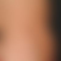 Dermatitis, phototoxic. general view (stage of healing): Strip-shaped, dark brown hyperpigmentati...