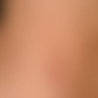 Dermatitis, phototoxic. general view (stage of healing): Strip-shaped, dark brown hyperpigmentati...