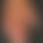 Dermatitis, phototoxische. Übersichtsaufnahme: Ausgeprägte Erytheme an den Fingern der linken Han...