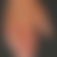 Dermatitis, phototoxische. Übersichtsaufnahme: Ausgeprägte Erytheme an den Fingern der linken Han...