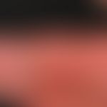Dermatitis, phototoxische. Detailvergrößerung: Ausgeprägte Erytheme an den Fingern der linken Han...