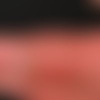 Dermatitis, phototoxische. Detailvergrößerung: Ausgeprägte Erytheme an den Fingern der linken Han...