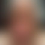 Dermatitis, phototoxische:&nbsp;chronische Dermatitis mit fein-bis groblamellärer Abschuppung der...
