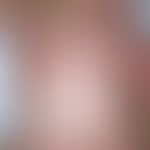 Dermatitis seborrhoides infantum. generalized dermatitis with fine to coarse lamellar scaling on ...