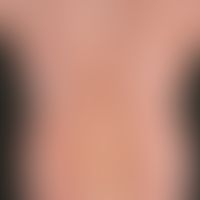 Dermatitis solaris:&nbsp;flächiges, scharf begrenztes, schmerzendes Erythem am Rücken, 10 Stunden...