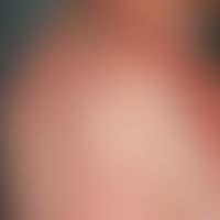 Bullöse Dermatitis solaris. Multiple, akute, seit 24 Std. bestehende, generalisierte, in UV-expon...