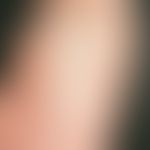 Dermatitis solaris: Verbrennung 1. Grades im Bereich des Stammes mit Aussparung der vom Arm bedec...