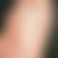 Dermatitis solaris: Verbrennung 1. Grades im Bereich des Stammes mit Aussparung der vom Arm bedec...