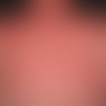 Dermatitis solaris. Nahezu universelles, sukkulentes Erythem bei einem 30-jährigen Patienten (Hau...
