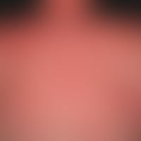 Dermatitis solaris. almost universal, succulent erythema in a 30-year-old patient (skin type II) ...
