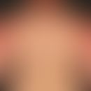 Dermatitis solaris: scharf auf Sonnenlicht-exponierte Areale gezeichnete, flächenhafte, sukkulent...
