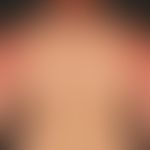 Dermatitis solaris: scharf auf Sonnenlicht-exponierte Areale gezeichnete, flächenhafte, sukkulent...