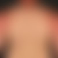 Dermatitis solaris: extensive, succulent, painful erythema in a 25-year-old man with skin type II...