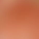 Dermatitis solaris. Detailaufnahme: Ausbildung von akuten, disseminierten Blasen auf einer fläche...