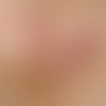Dermatofibrosarcoma protuberans.&nbsp;Derber plattenartig das Hautniveau unregelmaessig ueberrage...