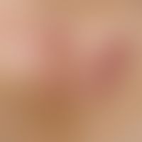 Dermatofibrosarcoma protuberans.&nbsp;Derber plattenartig das Hautniveau unregelmaessig ueberrage...