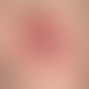Dermatofibrosarcoma protuberans: For many years a persistent, slowly growing, very coarse, bumpy,...