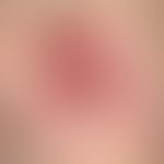 Dermatofibrosarcoma protuberans. Seit vielen Jahren persistierender, langsam wachsender, sehr der...