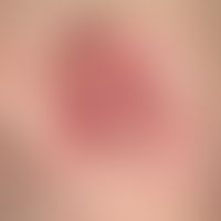 Dermatofibrosarcoma protuberans: For many years a persistent, slowly growing, very coarse, bumpy,...