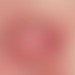 Dermatofibrosarcoma protuberans. Einzelner, chronisch stationärer, seit über 3 Jahren bestehender...