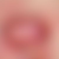 Dermatofibrosarcoma protuberans. Einzelner, chronisch stationärer, seit über 3 Jahren bestehender...