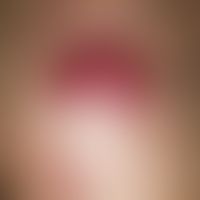 Dermatofibrosarcoma protuberans. Solitärer, chronisch dynamischer, seit 4-5 Jahren kontinuierlich...