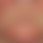 Dermatomyositis. Chronisch stationäres, flächiges, rotes, "heliotropes" &nbsp;Exanthem. Typisch a...
