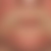 Dermatomyositis. Chronisch stationäres, flächiges, rotes, "heliotropes" &nbsp;Exanthem. Typisch a...