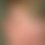 Dermatomyositis. Flächige, rot-livide Flecken im Gesicht einer 55-jährigen Frau mit periorbitaler...