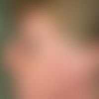 Dermatomyositis. Flächige, rot-livide Flecken im Gesicht einer 55-jährigen Frau mit periorbitaler...